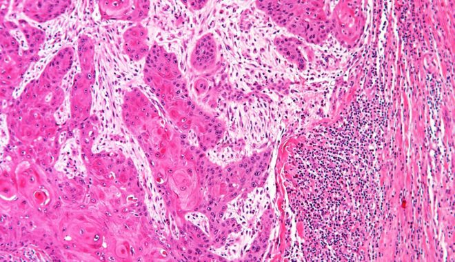 A human head and neck cancer (HNSCC) under the microscope. The pink islands are the cancer cells; these are surrounded by paler cells (the cancer associated fibroblast, or CAFs, and on the right of the image are lymphocytes. These appear as small black dots, which fail to infiltrate into the cancer due to the CAFs