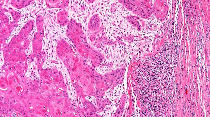 A human head and neck cancer (HNSCC) under the microscope. The pink islands are the cancer cells; these are surrounded by paler cells (the cancer associated fibroblast, or CAFs, and on the right of the image are lymphocytes. These appear as small black dots, which fail to infiltrate into the cancer due to the CAFs